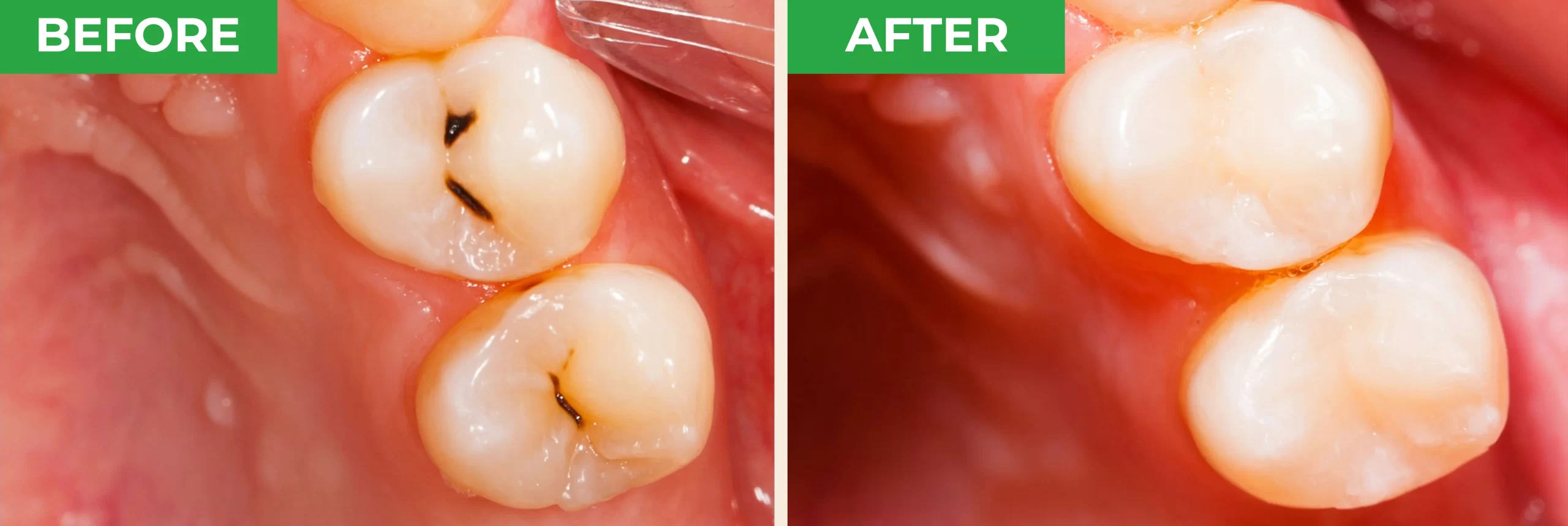 ProXental Before and After